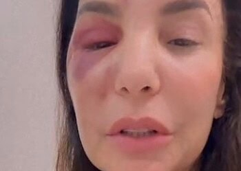 Ivete Sangalo fala sobre cirurgia que fez no rosto após queda no banheiro: 'Houve uma ruptura de osso'