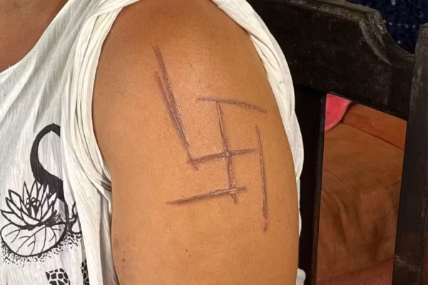 'Tenho que trocar a minha pele', diz mulher trans marcada com símbolo nazista durante tortura