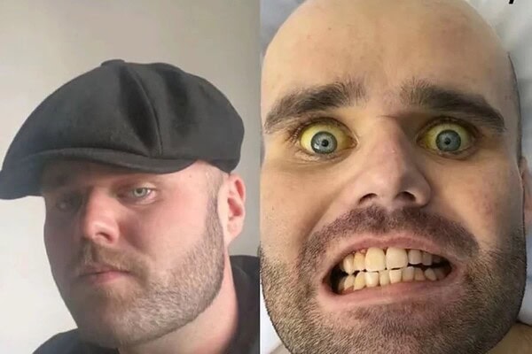 Vício em beber vodca no café da manhã deixa homem com pele amarelada